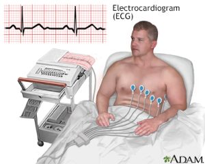 EKG