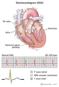 EKG