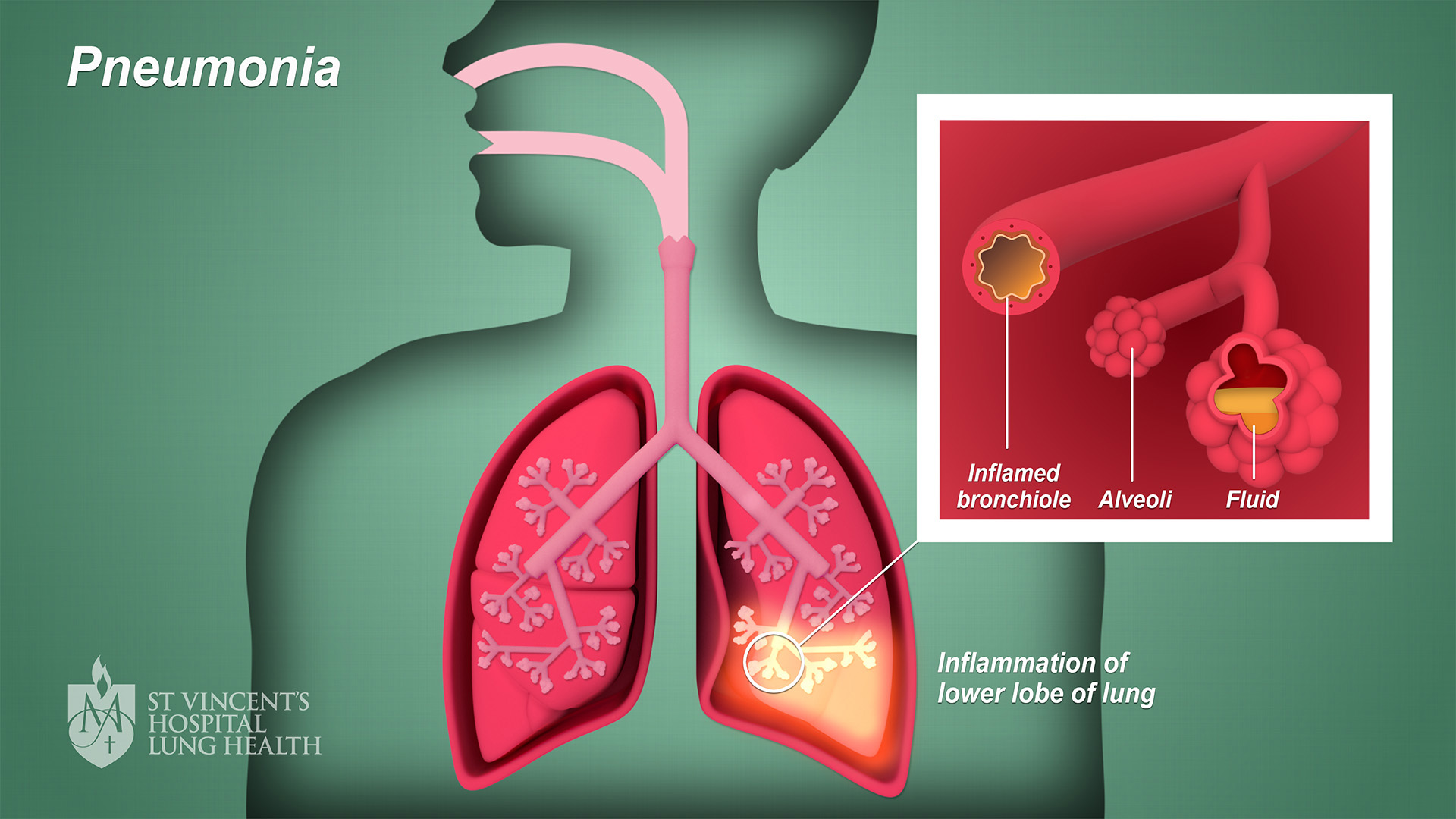 Pneumonia