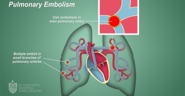 Pembekuan Darah Emboli Pada Pembuluh Darah Paru