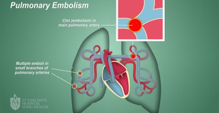 Pembekuan Darah Emboli Pada Pembuluh Darah Paru