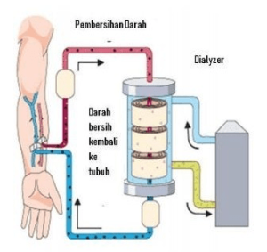 Cara Kerja Alat Hemodialisa Pada Penderita Gagal Ginjal